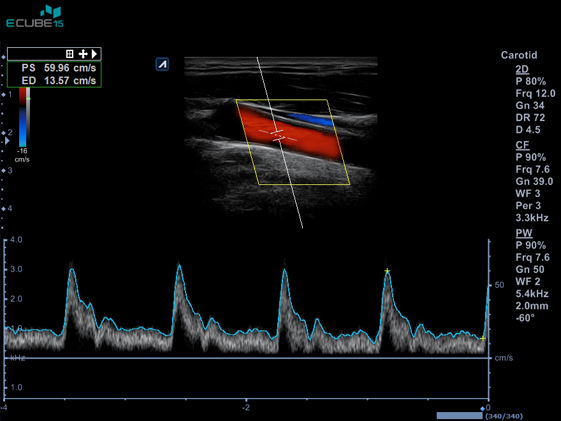 1_Auto_calculation_mode_of_carotid_arter_spectrum5.jpg